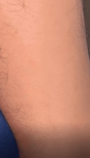 Skin After using Shevra